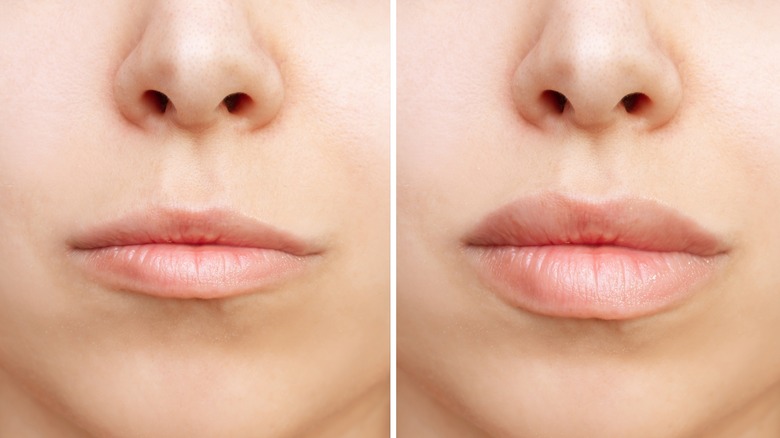 Lip Fillers: Who Can Go For the Process and Why