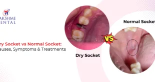 Dry Socket vs Healthy Socket: Symptoms Explained